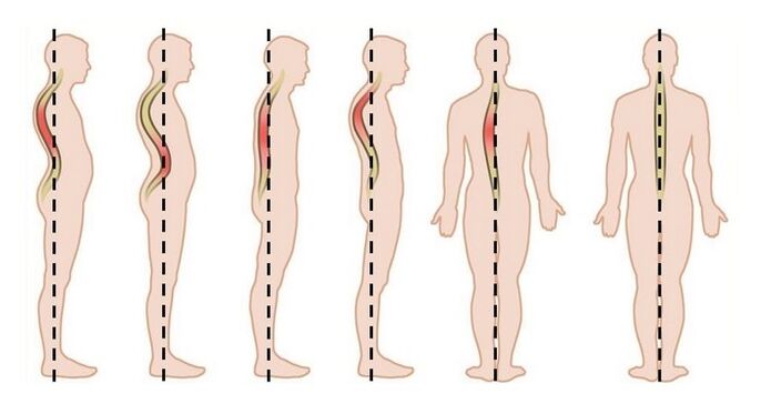 нарушения на стойката като причина за гръдна остеохондроза