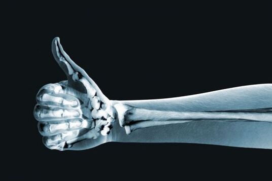 Рентгеновата снимка може да помогне за диагностициране на болка в ставите на пръстите