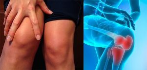 Дискомфортът и подуването в областта на коляното са първите симптоми на артроза